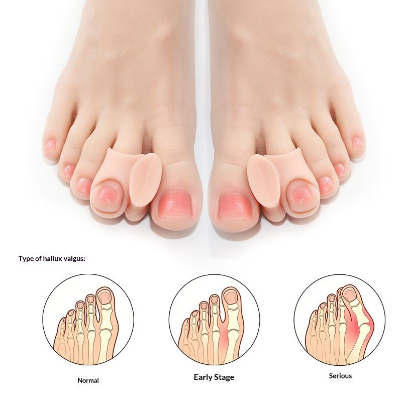 1 Pairs Silicone Toe Separator - đánh giá và giá Toe Separator Silicon
