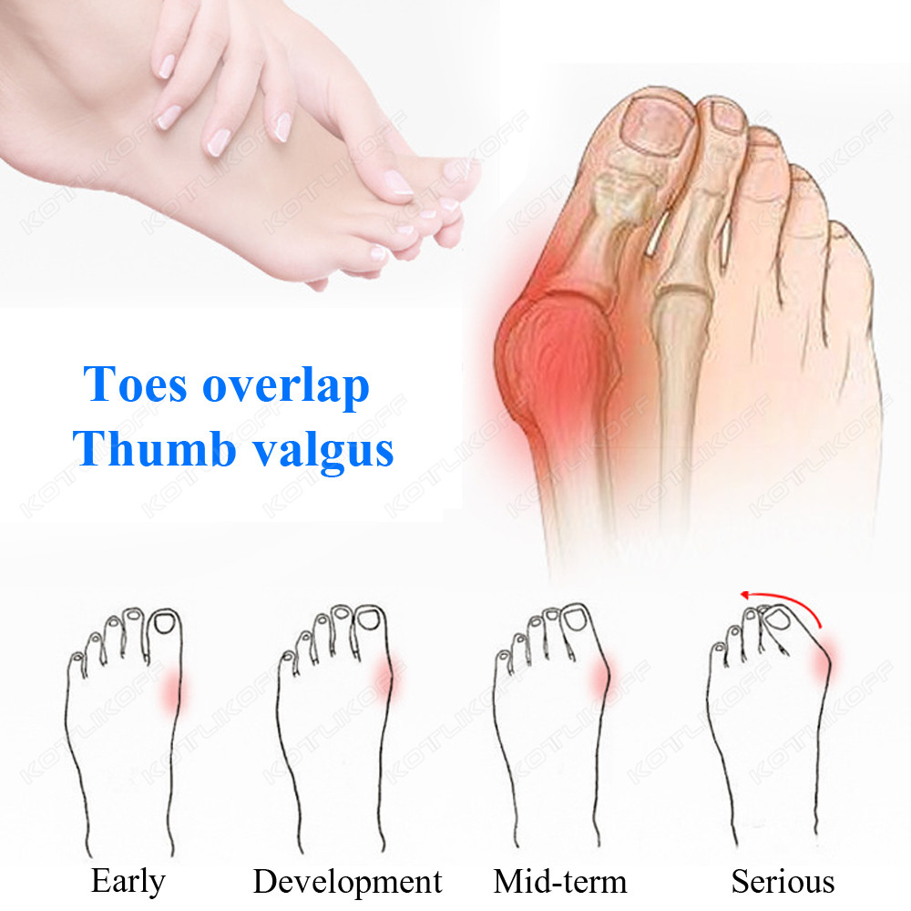 Toe Protective Toes Separator  - đánh giá và giá Toe Separator Silicon