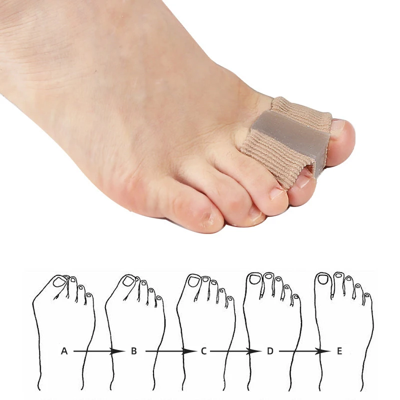 New Toe Separator Hallux Valgu - đánh giá và giá Toe Separator Silicon